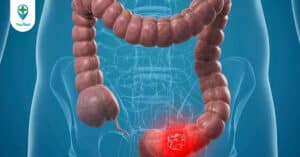 Bệnh ung thư đại tràng sống được bao lâu?