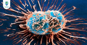 Những điều bạn nên biết về bệnh ung thư bàng quang di căn