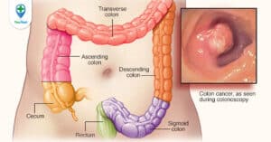 Bệnh nhân mắc ung thư đại tràng có chữa được không?