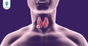 Bướu tuyến giáp ác tính và những sự thật bạn cần biết