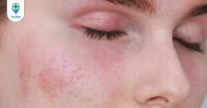 Tại sao bạn cảm thấy ngứa da mặt? Điều trị như thế nào để nhanh hết?