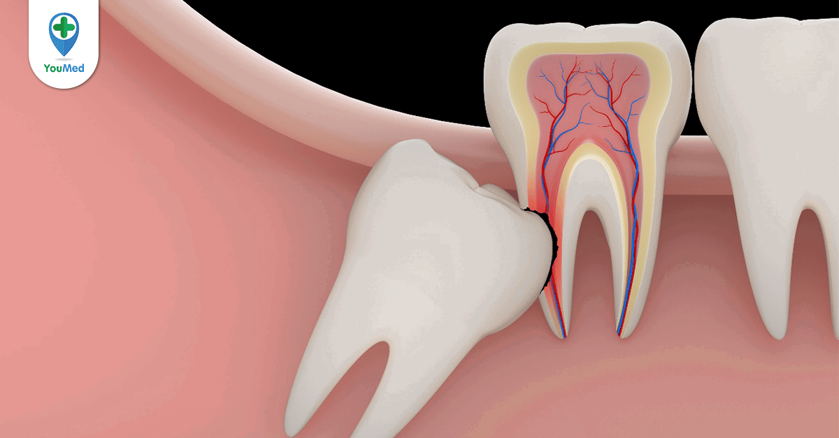 Quá trình nhổ răng khôn diễn ra như thế nào?
