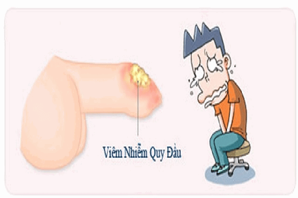 Ảnh hưởng của bao quy đầu dài