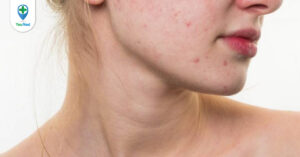 Da nhiễm corticoid: Nguyên nhân, dấu hiệu nhận biết và cách điều trị