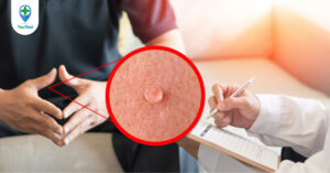 Gai sinh dục và sùi mào gà: Phân biệt và phòng tránh