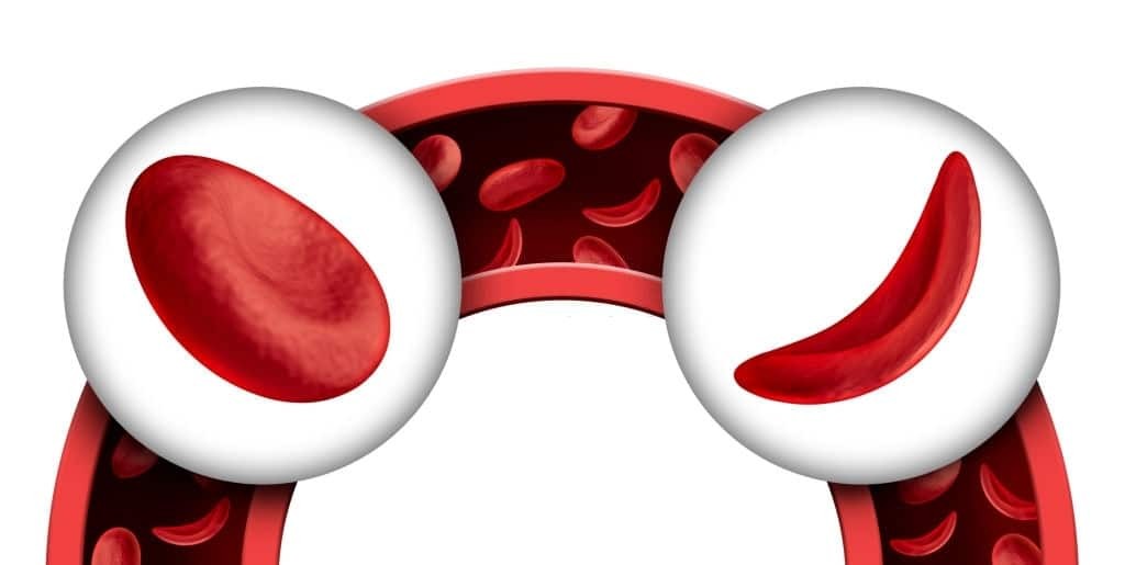 hồng cầu hình liềm là nguyên nhân thiếu máu ở trẻ em