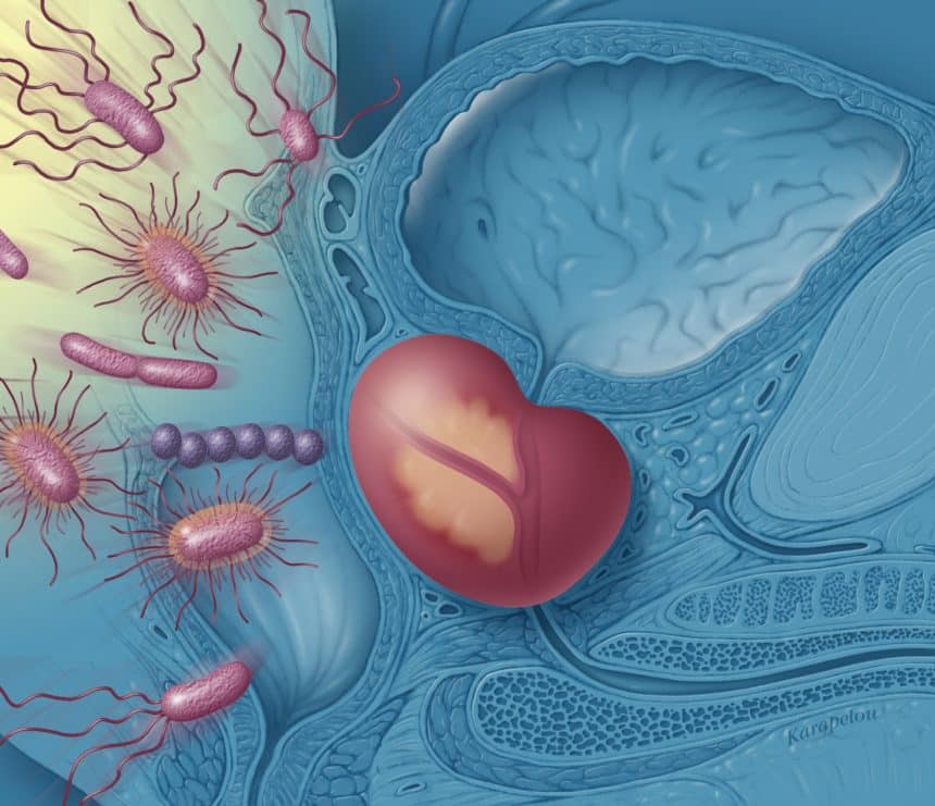 Vi khuẩn là nguyên nhân chính của viêm tuyến tiền liệt