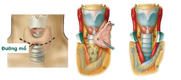 Phẫu thuật cắt tuyến giáp trong điều trị bệnh Basedow