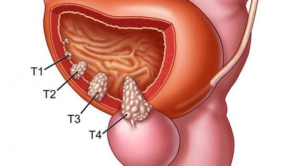 Chữ "T" mô tả kích thước và độ xâm lấn của khối u đến các lớp trong bàng quang