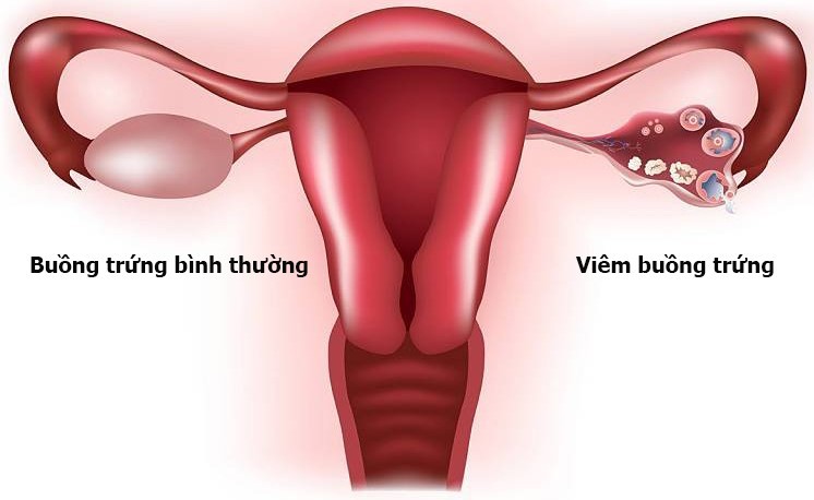 Quai bị có thể gây biến chứng viêm buồng trứng ở nữ giới