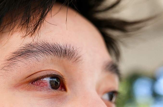 Viêm kết mạc là tình trạng viêm mô kết mạc ở mắt
