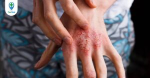 Viêm da cơ địa và các biểu hiện: Liệu bạn đã biết?