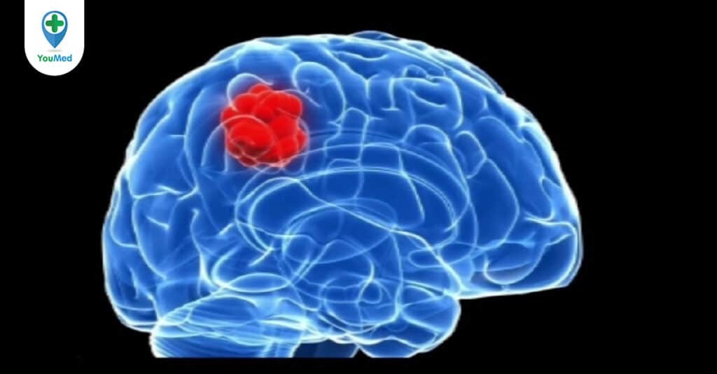 Ung thư não thứ phát: nguyên nhân, triệu chứng và điều trị
