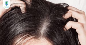 Cách trị dứt điểm ngứa da đầu