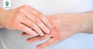 Hiểu đúng về nguyên nhân gây ra bệnh viêm da cơ địa