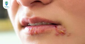 Nhiễm trùng da: Những điều bạn cần biết