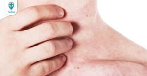 Bật mí cách trị ngứa ở từng vùng da hiệu quả, an toàn
