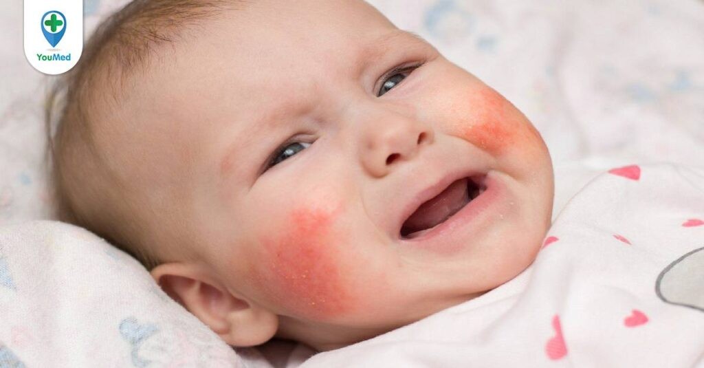 Bệnh viêm da cơ địa ở trẻ em