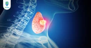 Bướu giáp keo: Triệu chứng, chẩn đoán và điều trị