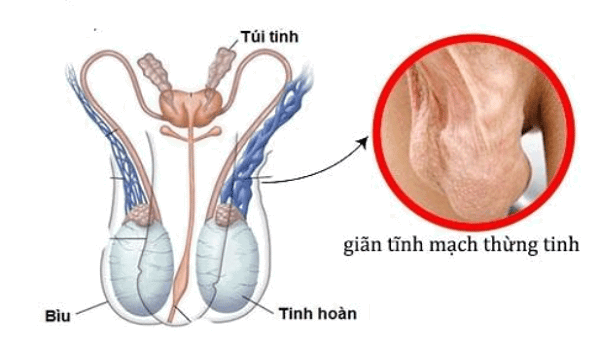 Giãn tĩnh mạch thừng tinh là nguyên nhân gây tinh trùng loãng