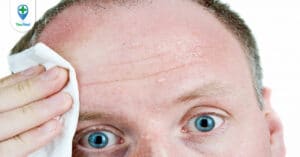 Bệnh đổ mồ hôi đầu nhiều: nguyên nhân và cách khắc phục