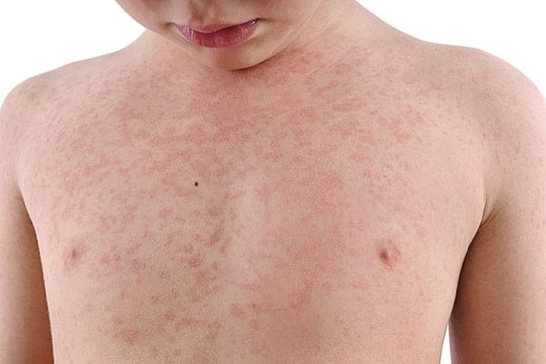 Sởi do một loại virus thuộc họ paramyxovirus gây ra