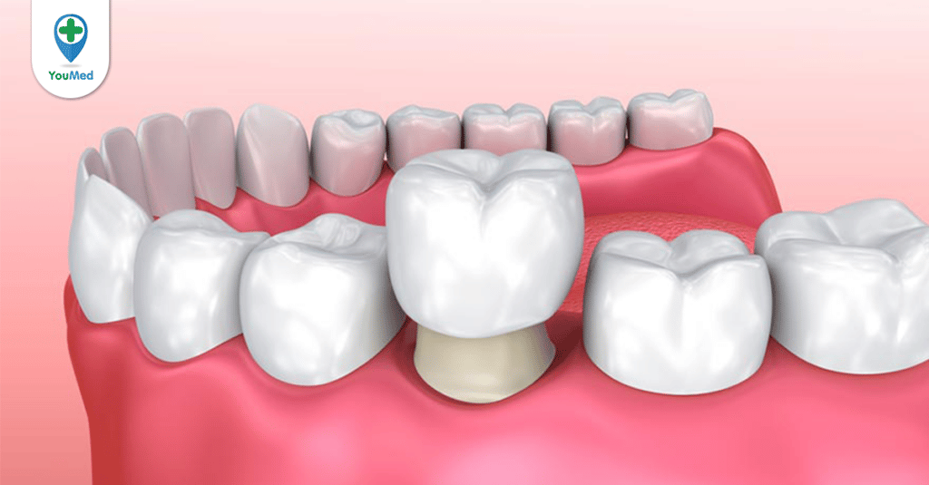 Review bọc răng sứ ở bệnh viện Răng Hàm Mặt
