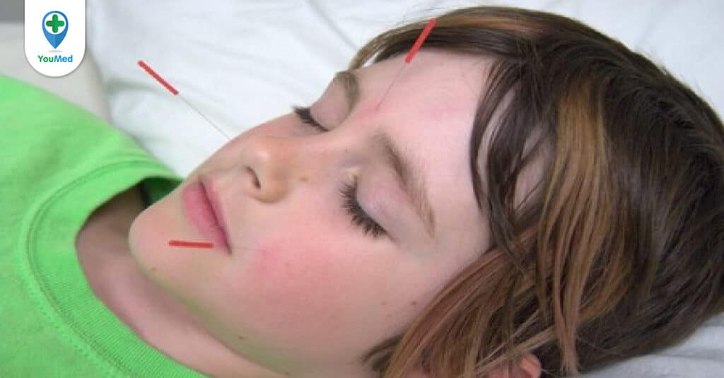 Châm cứu cho trẻ tự kỷ và những điều bạn cần nên biết