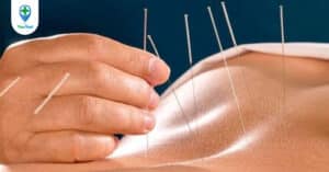 Châm cứu vùng lưng và các huyệt vùng lưng thường dùng