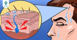 Đổ mồ hôi nhiều ở mặt do đâu và cách khắc phục