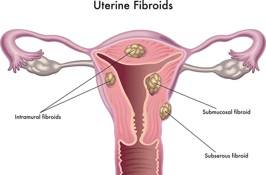 U xơ tử cung làm dày lên lớp niêm mạc tử cung, làm tăng lượng máu kinh