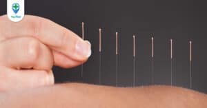 Những phương pháp châm cứu có thể bạn chưa biết