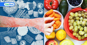 Viêm da cơ địa kiêng ăn gì? Câu trả lời từ bác sĩ