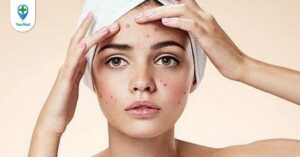 Mách bạn 10 cách trị mụn với những nguyên liệu thiên nhiên