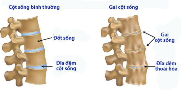 Hầu như bệnh gai cột sống có thể ảnh hưởng lên bất cứ phần nào của cột sống.