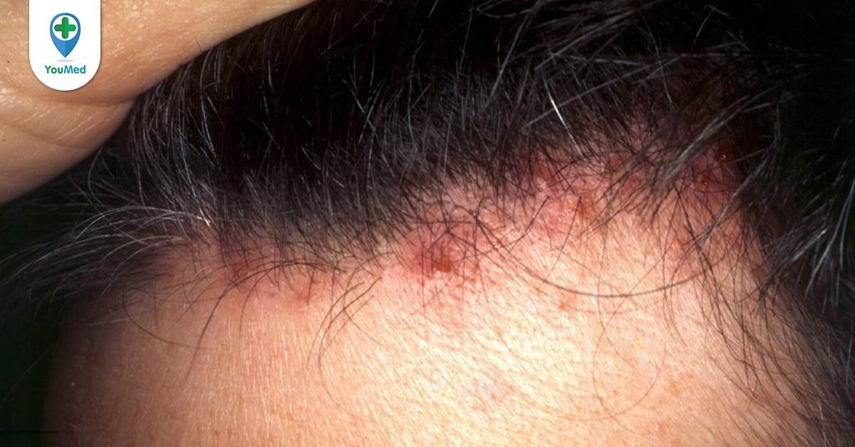  Mụn đỏ trên da đầu : Nguyên nhân và cách điều trị hiệu quả