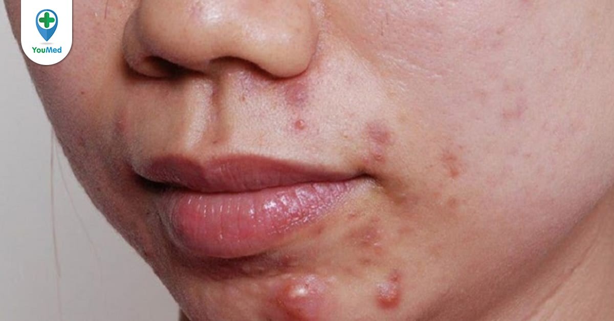 Có những bước cần lưu ý khi chăm sóc da mụn quanh miệng và cằm không?