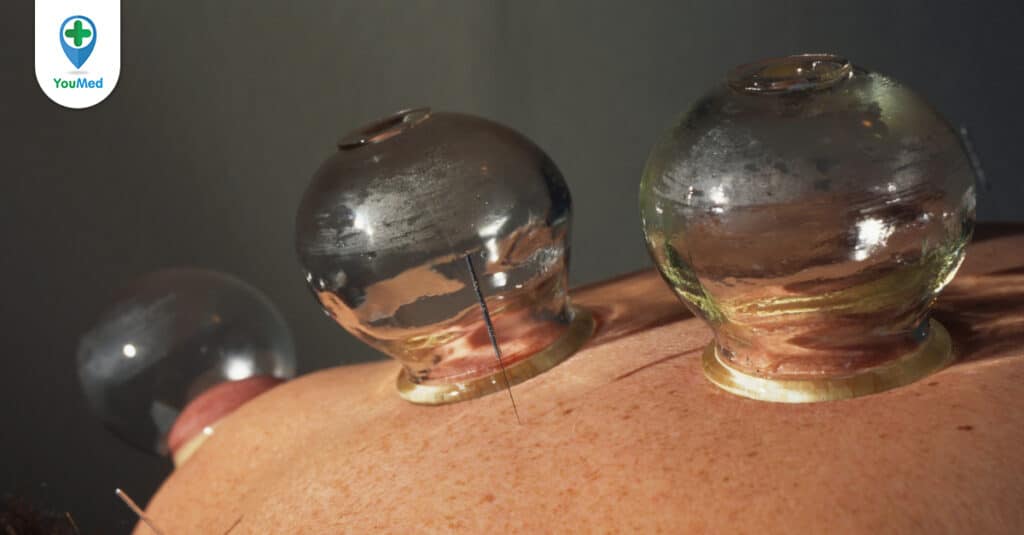 Cùng bác sĩ tìm hiểu cách giác hơi chữa bệnh