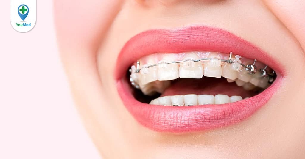 Những điều bạn nên biết về niềng răng mắc cài sứ tự buộc