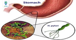 Viêm dạ dày HP: Những điều bạn cần biết