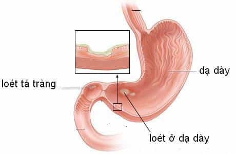 Viêm dạ dày nếu không điều trị kịp thời có thể dẫn tới loét dạ dày