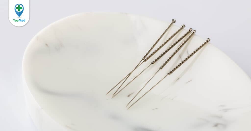 Thông tin về phương pháp châm cứu chữa đái dầm