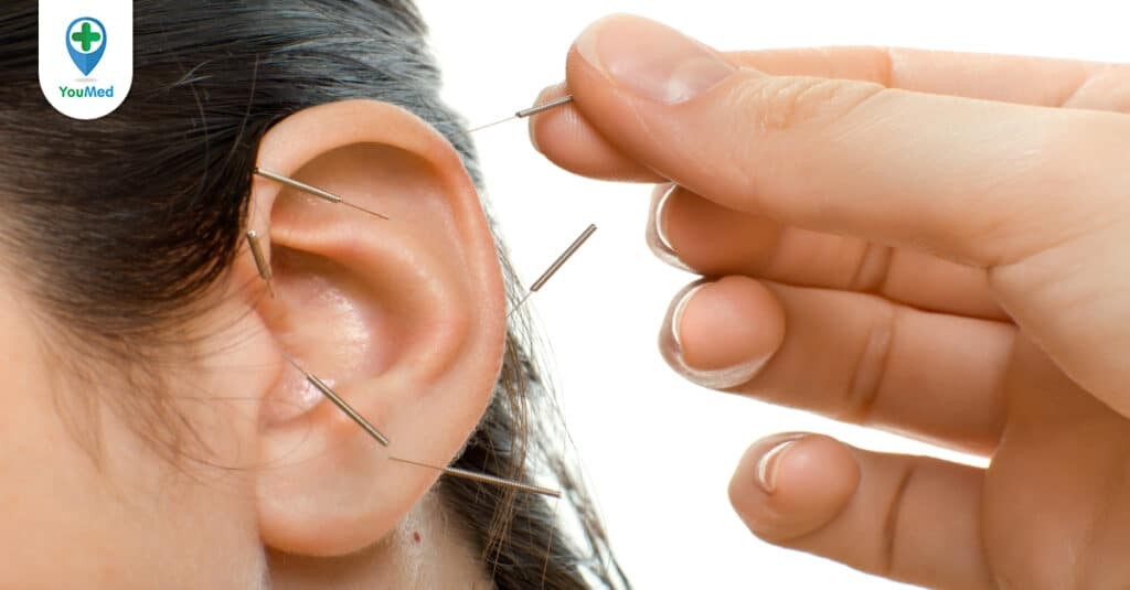 Châm cứu chữa ù tai: tác dụng, phương pháp châm và lưu ý