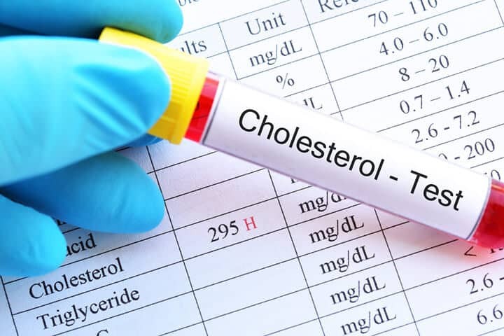 Tăng cholesterol là bằng chứng của rối loạn chuyển hóa lipid 
