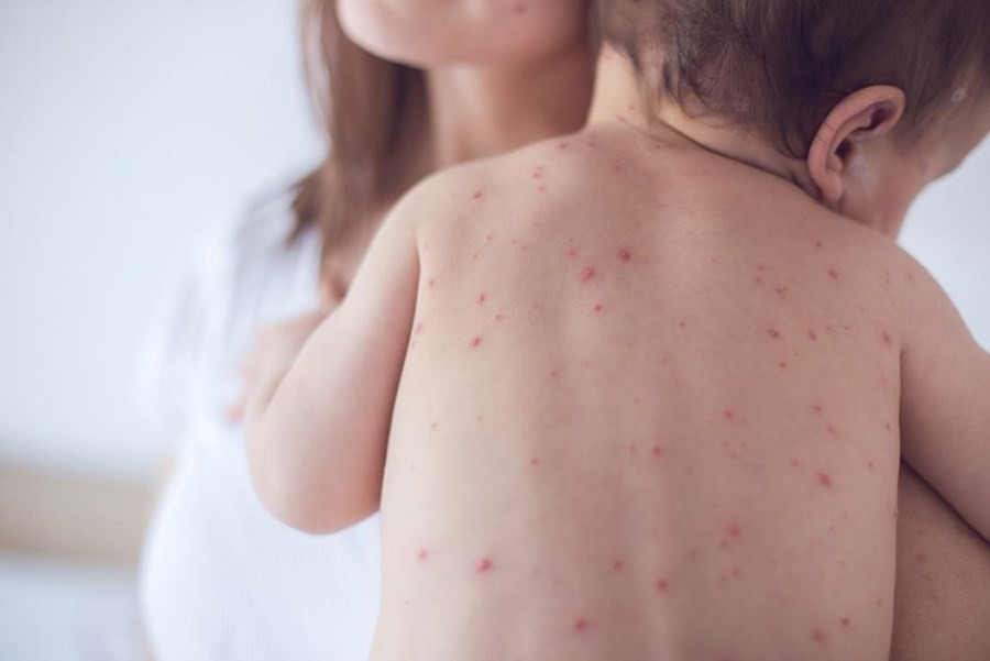 Trẻ là đối tượng dễ mắc bệnh sởi - quai bị - rubella