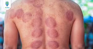 Sự thật về việc có nên giác hơi toàn thân?