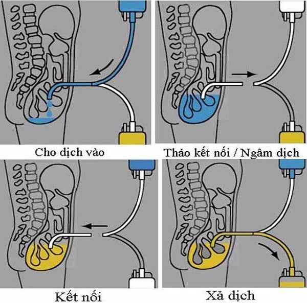 Thẩm phân phúc mạc