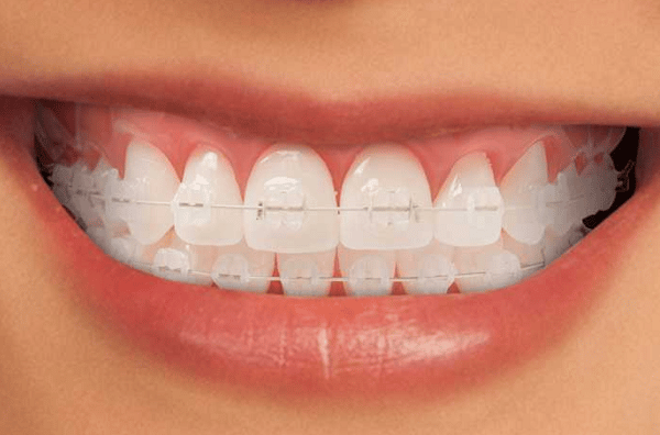 Quy trình niềng răng