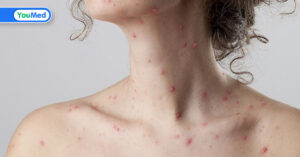 Sởi và rubella khác nhau như thế nào?