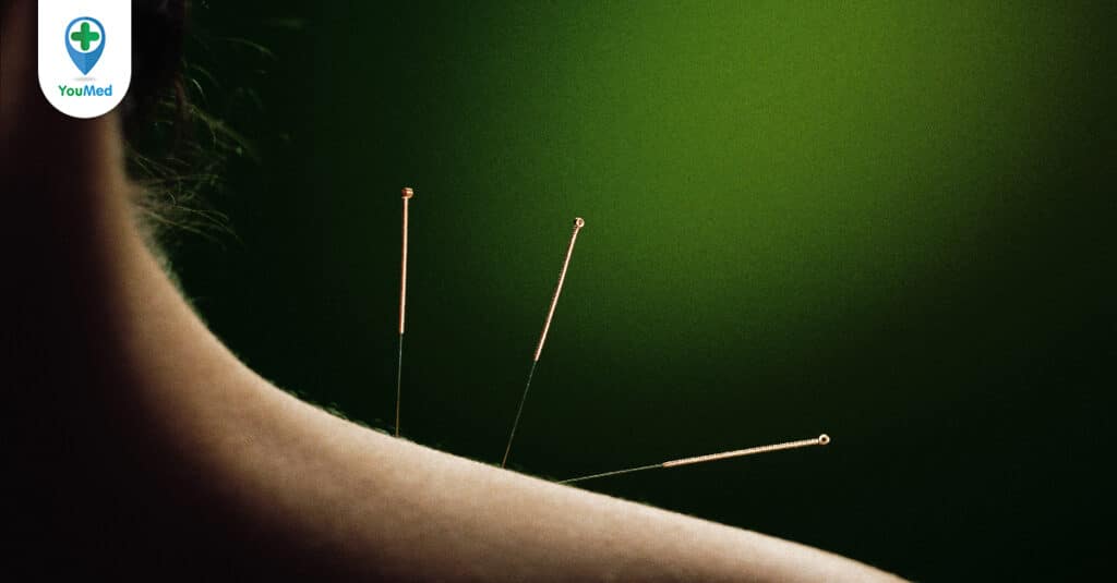 Châm cứu chữa thoái hóa đốt sống cổ và những thông tin cần biết